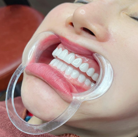 Bọc Răng Sứ 2 Răng Cửa: Giải Pháp Thẩm Mỹ Hoàn Hảo Cho Nụ Cười
Một nụ cười đẹp luôn là yếu tố...