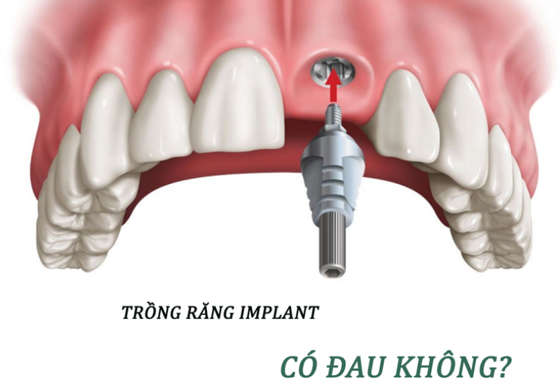 Cấy ghép implant có đau không? Thời gian hồi phục?
Nhiều người dù đã nghe qua phương pháp cấy ghép...