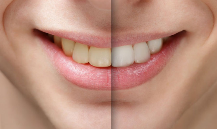 Răng sứ bị xỉn màu? Giải mã nguyên nhân và cách khắc phục
Khi chiếc răng sứ bạn chăm sóc mất đi màu...