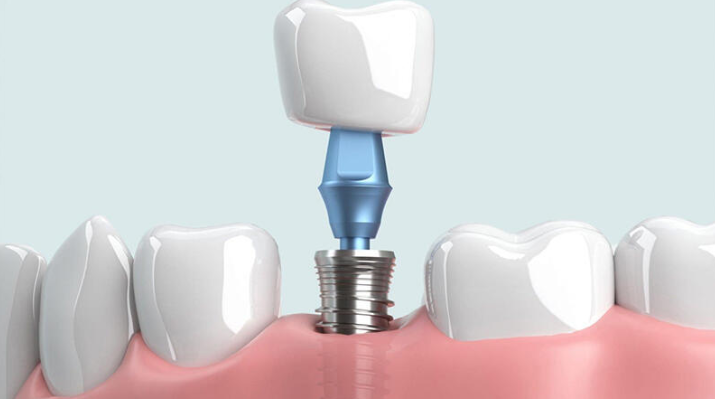 Trồng răng Implant vĩnh viễn có nên hay không nên?
Việc mất răng không chỉ ảnh hưởng đến thẩm mỹ mà...