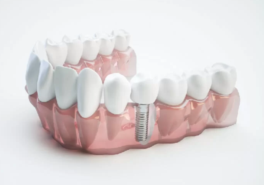 Trồng Răng Implant Bao Lâu Thì Ăn Được? Câu Hỏi Đáng Quan Tâm Của Mọi Bệnh Nhân
Khi quyết định...