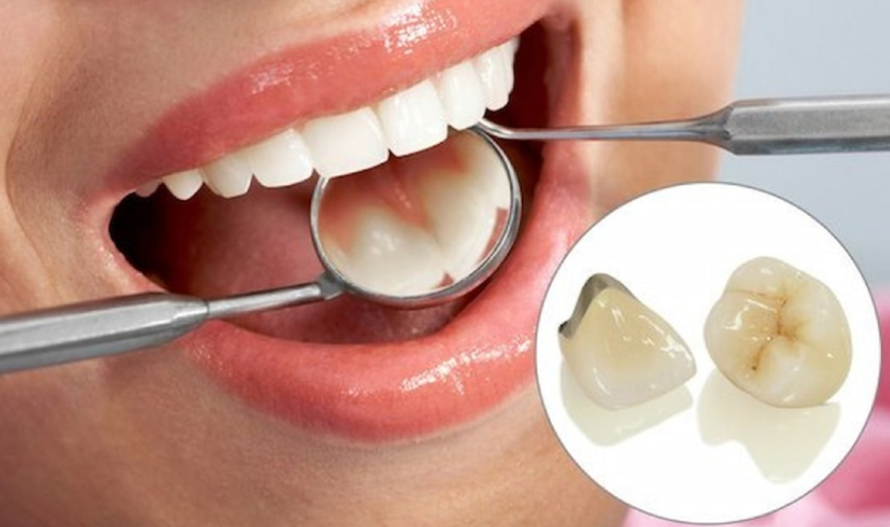 Răng vỡ lớn có bọc sứ được không? Chuyên gia giải đáp cụ thể
Răng bị vỡ lớn là tình trạng phổ biến...