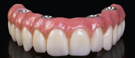 Trồng Răng Implant Có Đau Không? Bác Sĩ Nói Gì Về Nỗi Lo Phổ Biến
Nỗi sợ đau luôn là rào cản tâm lý...