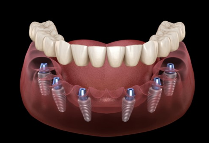 Kỹ thuật trồng răng implant All on 4 và All on 6 là gì
Khi mất răng toàn hàm, nhiều người lo ngại...