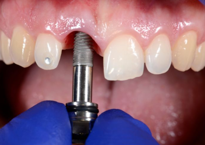 Trồng răng implant toàn hàm Nha khoa Sing có tốt không?
Khi mất răng toàn bộ hoặc gần như toàn bộ...