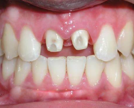 Răng Cửa Bị Sâu Có Trám Được Không? Câu Trả Lời Từ Chuyên Gia Nha Khoa
Trong số các vị trí răng bị...