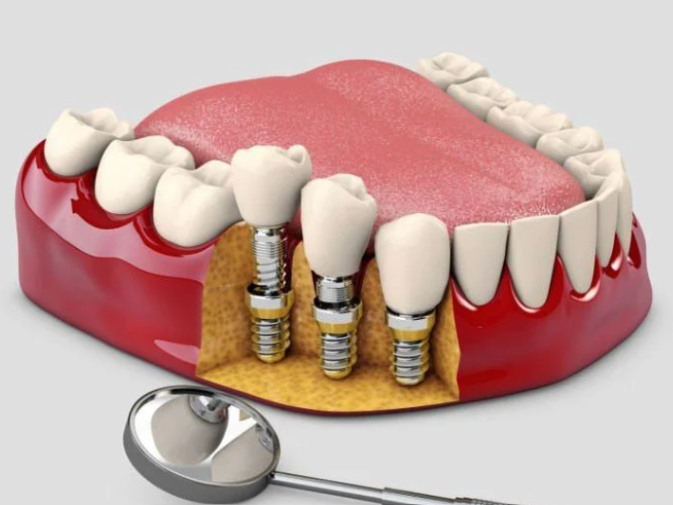 Trồng răng cấy trụ implant là gì? Bao nhiêu tiền? Nên làm ở đâu?
Ngày nay, khi công nghệ nha khoa...