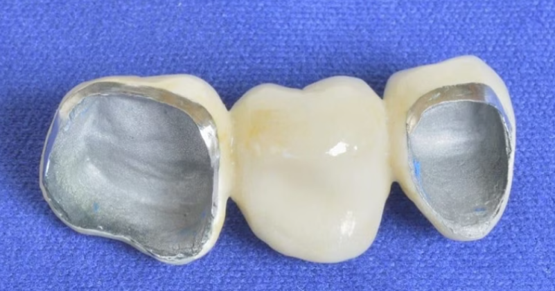 Cầu răng sứ là một trong những giải pháp phổ biến giúp phục hồi răng mất hiệu quả cả về thẩm mỹ lẫn...