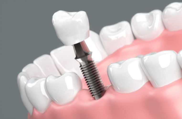 Review trồng răng implant Hà Nội: Nơi nào đáng tin cậy, bác sĩ giỏi?

Bạn đang mất răng và được...