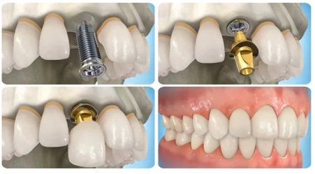 Trồng Răng Implant Giá Rẻ: Giải Pháp Kinh Tế Hay Tiềm Ẩn Rủi Ro?
Khi nhu cầu trồng răng implant...