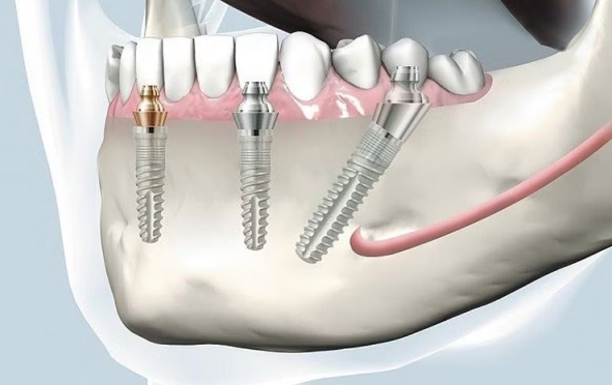 Cùng tìm hiểu quy trình trồng răng implant Nha Khoa Sing
Mất răng không chỉ ảnh hưởng đến thẩm mỹ...