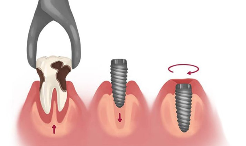 Trồng răng cấy ghép Implant – Giải pháp hiện đại giúp bạn ăn nhai vững vàng, nụ cười rạng rỡ
Mất...