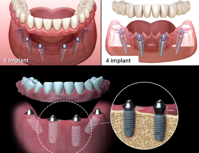 Nên chọn trồng răng Implant ở đâu Hà Nội uy tín?
Mất răng không chỉ gây khó khăn trong ăn uống,...