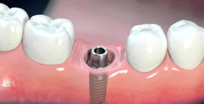 Trước và sau khi trồng răng implant: Những điều cần biết để không hối hận

Trồng răng Implant là...