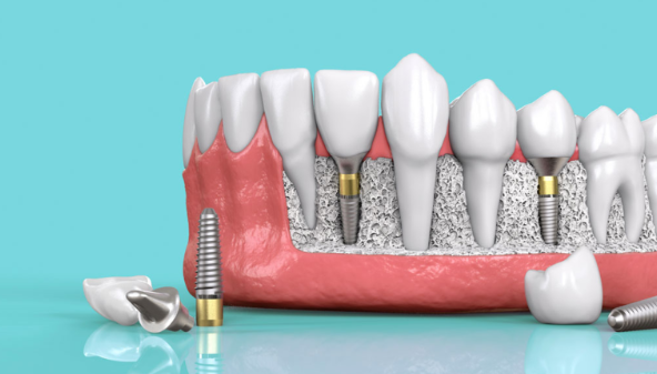 Trồng răng implant: Giải pháp bền vững cho răng mất
Mất răng không chỉ ảnh hưởng đến khả năng ăn...