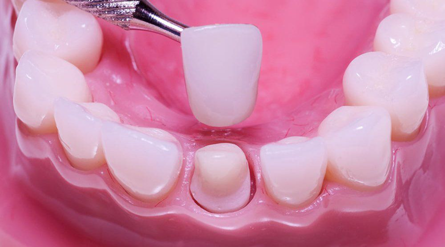 Khi Nào Thì Nên Bọc Răng Sứ 2 Răng Cửa? 

Răng cửa – “mặt tiền” của nụ cười – không chỉ đóng vai...