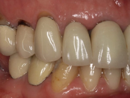 Sau Khi Nhổ Răng Bao Lâu Thì Trồng Implant? Tìm Hiểu Thời Gian Và Quy Trình Cấy Ghép Răng...