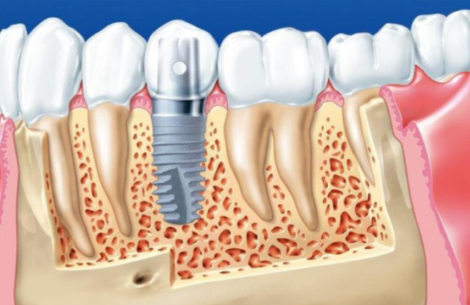Ở Hà Nội nên lựa chọn địa chỉ trồng răng Implant nào uy tín?
Trồng răng Implant hiện nay đang được...