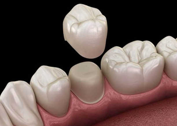 Bọc răng sứ tại nha khoa Sing: Chuyên gia giải đáp thắc mắc
Bọc răng sứ là một trong những giải...