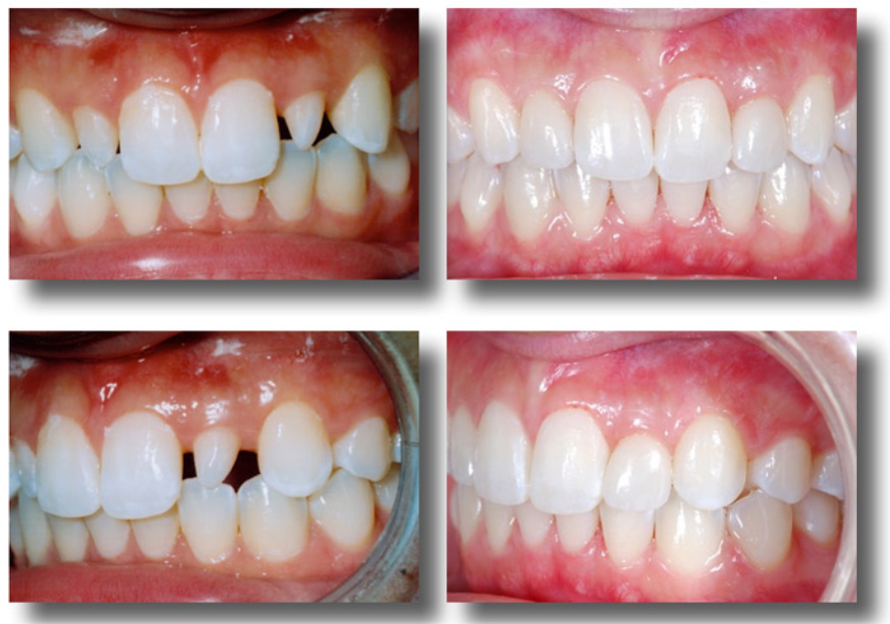 Boc rang su nha khoa Sing: Tan tam, uy tin, minh bach

Trong hanh trinh cham soc suc khoe rang...