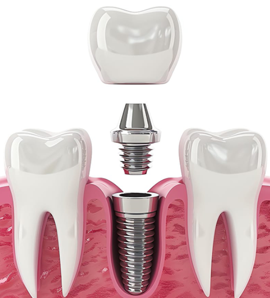 Trong rang Implant: Tu tham kham den phuc hinh hoan thien
Khi mat rang vinh vien thi nhu cau khoi...