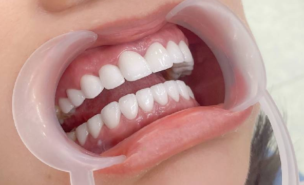  Giải đáp  Bọc răng sứ bị đen nướu? 3 cách khắc phục
Sau khi bọc răng sứ, nhiều người bất ngờ nhận...