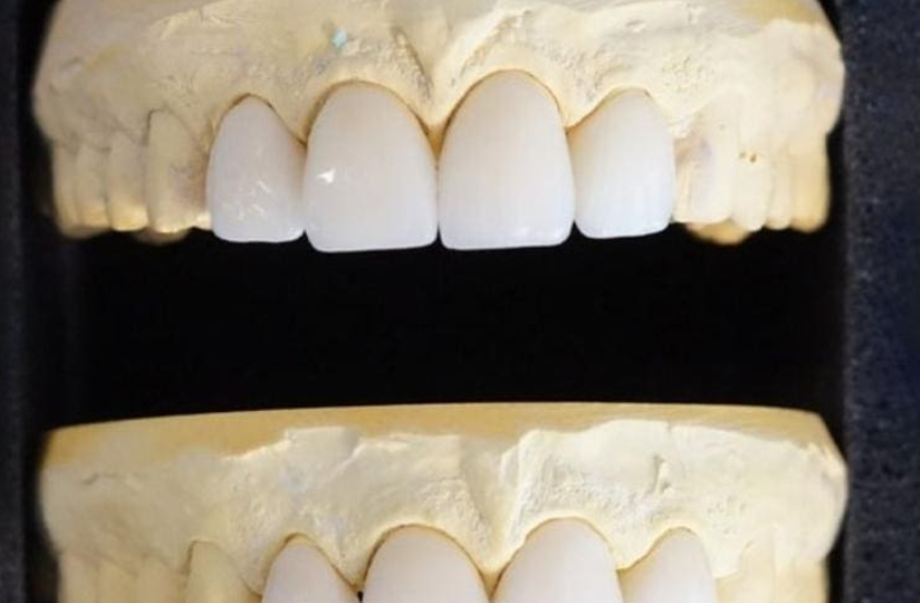 Những trường hợp không nên bọc răng sứ
Bọc răng sứ từ lâu đã được xem là giải pháp thẩm mỹ và phục...