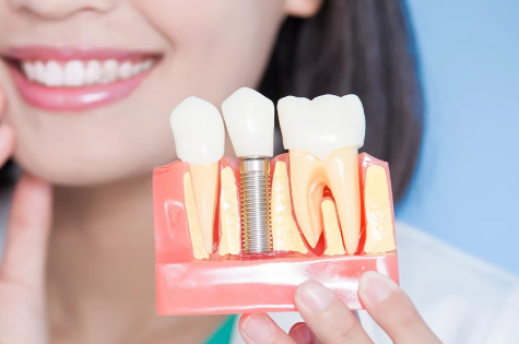 Trồng răng implant số 6 là gì? Quy trình thực hiện
Răng số 6 là chiếc răng hàm lớn đóng vai trò...