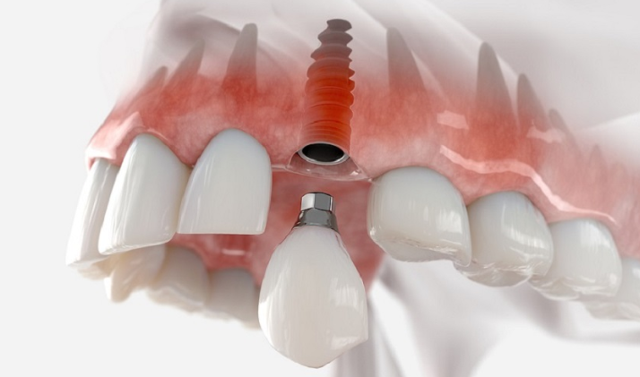 Nha khoa Nam Dinh: Huong dan tham kham tai nha khoa Sing
Cham soc rang mieng dang tro thanh noi...